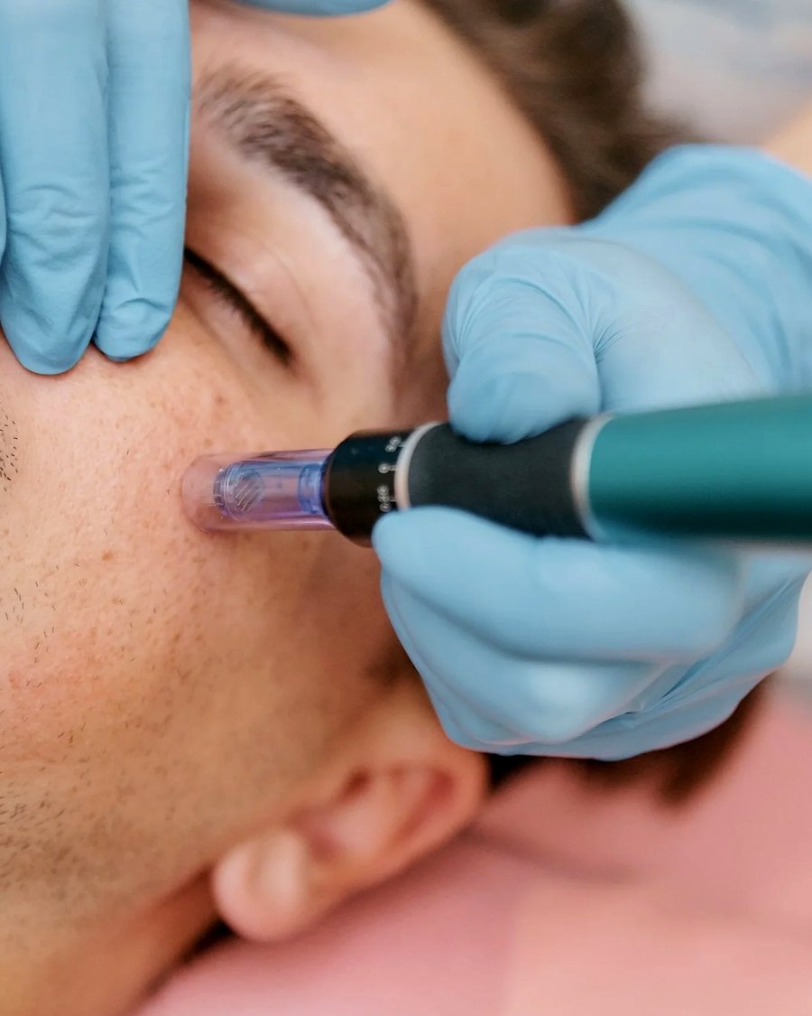 Microchanneling collagen treatment